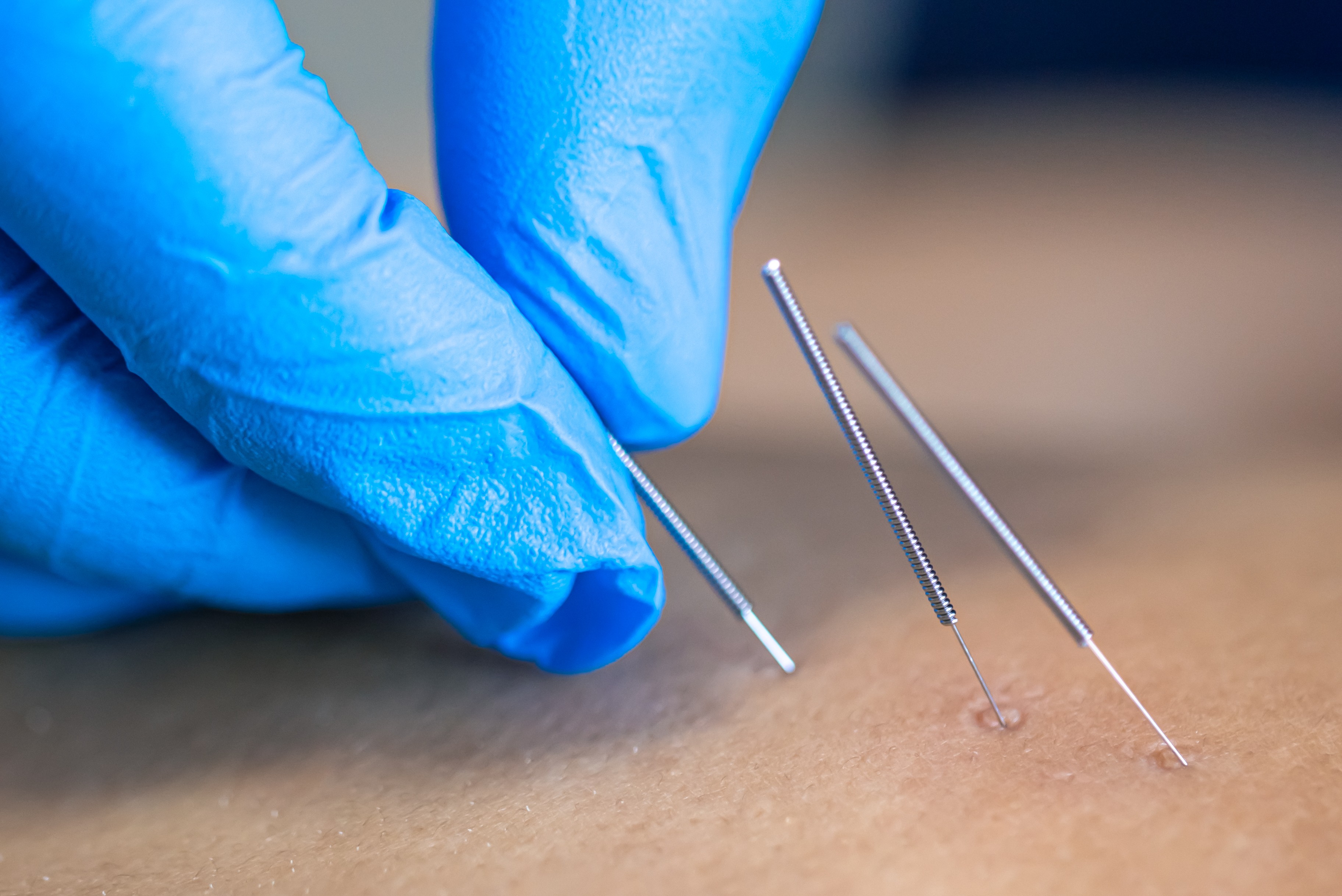 Dry Needling